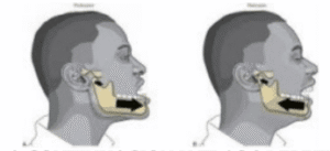 fisioterapia-rehabilitacion-centro-larios-atm-01